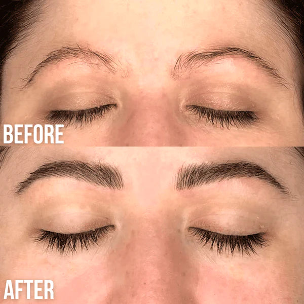 eyebrow lift before and after